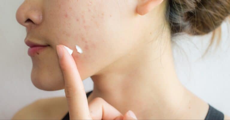 Cancer-Causing Chemical Can Form in Popular Acne Treatment Products
